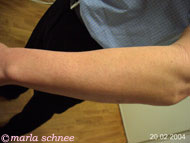 Haarentfernung Lightsheer: Unterarm nachher