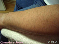 Haarentfernung Laser: Unterarm nachher