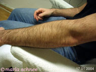 Haarentfernung Lightsheer: Unterarm vorher